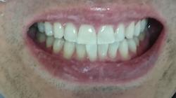 パール歯科ホワイトニングの常連さんです👍