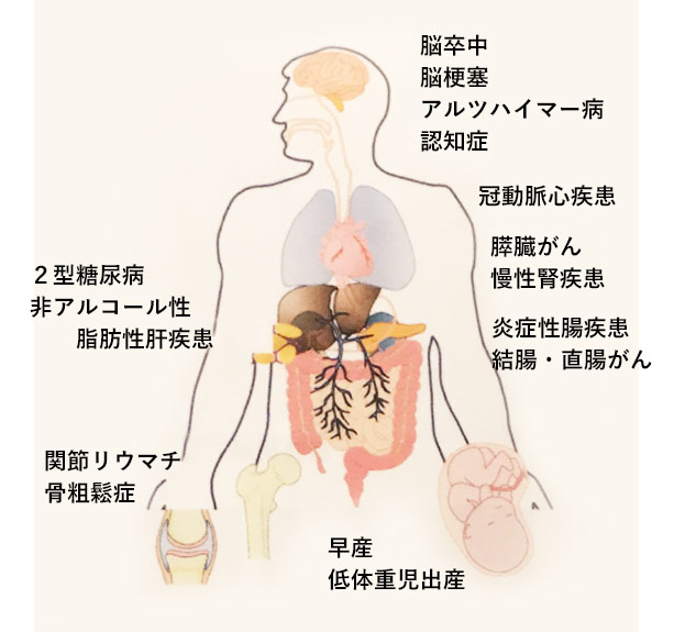 歯周病が全身に及ぼす影響