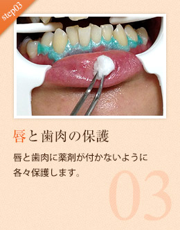 3.唇と歯肉の保護 唇と歯肉に薬剤が付かないように各々保護します。